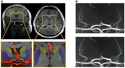 Morphological characteristics of lenticulostriate arteries in a large age-span population: Results from 7T TOF-MRA